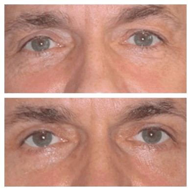 Recovery Tips for Eye Bag Fat Removal Surgery