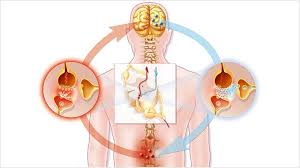 Overcoming Neuropathic Pain with Gabapentin 100