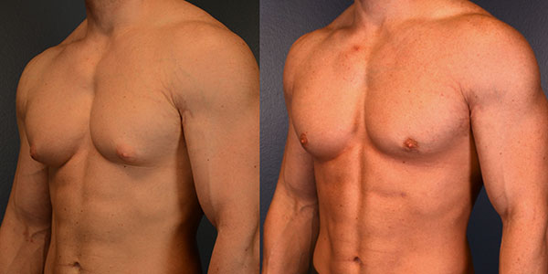 How to Choose the Best Time for Gynecomastia Surgery: A Comprehensive Guide